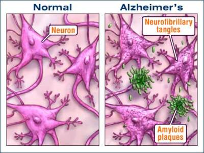 Health Beat: Unfortunately, No Alzheimer’s Miracle is in Sight