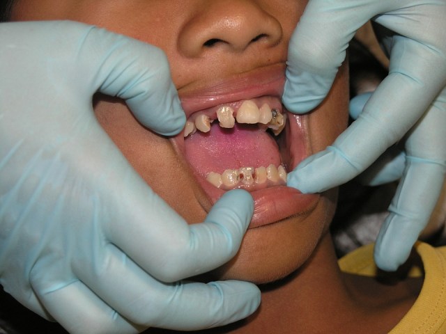 Children with bad teeth
