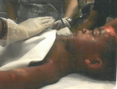 Four Years After A Toddler Died Of Scalding, Her Mother Still Seeks Answers
