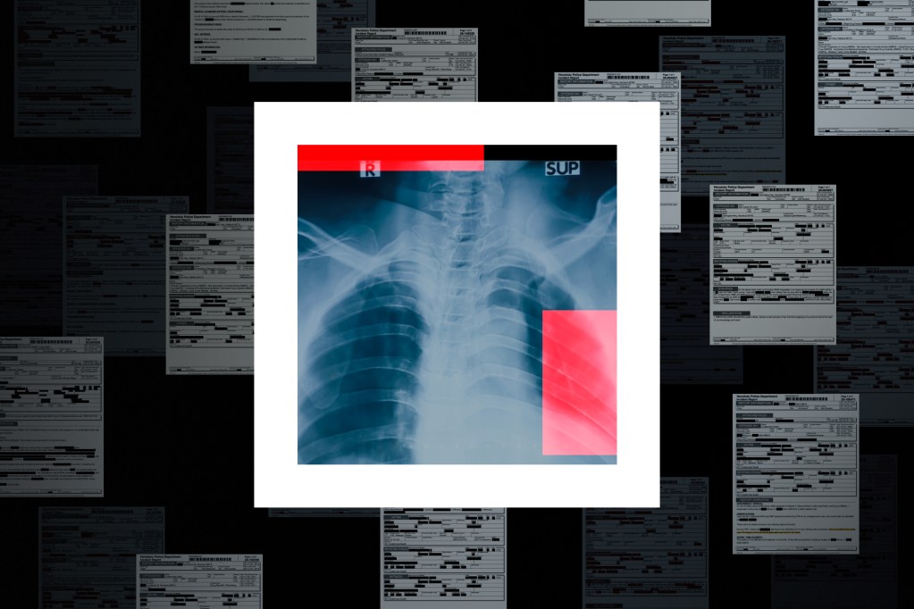 Photo illustration of a chest x-ray of a heart shown with multiple police reports of meth-related deaths.